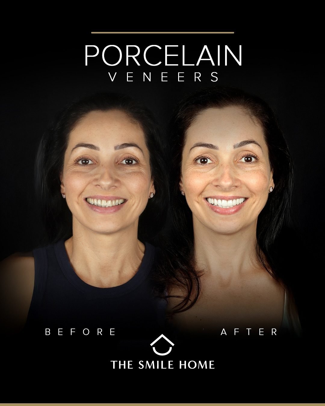 The Smile Home porcelain veneers before and after